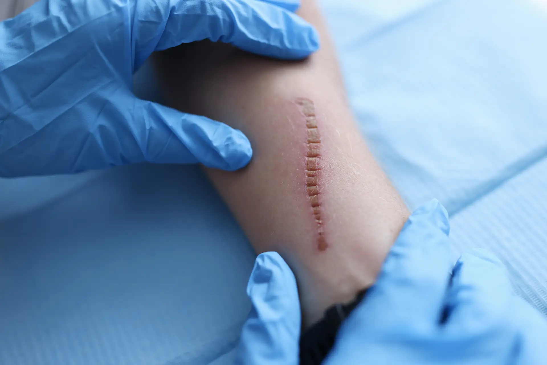 Scar Revision Surgery
